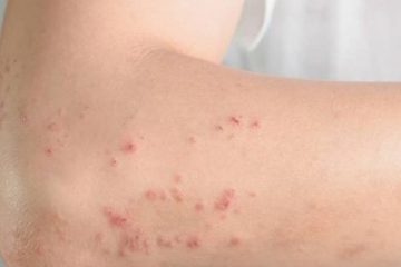 Dermatite atópica: 20% das crianças e 7% dos adultos brasileiros enfrentam a condição