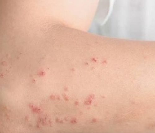Dermatite atópica: 20% das crianças e 7% dos adultos brasileiros enfrentam a condição