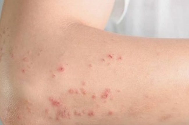 Dermatite atópica: 20% das crianças e 7% dos adultos brasileiros enfrentam a condição
